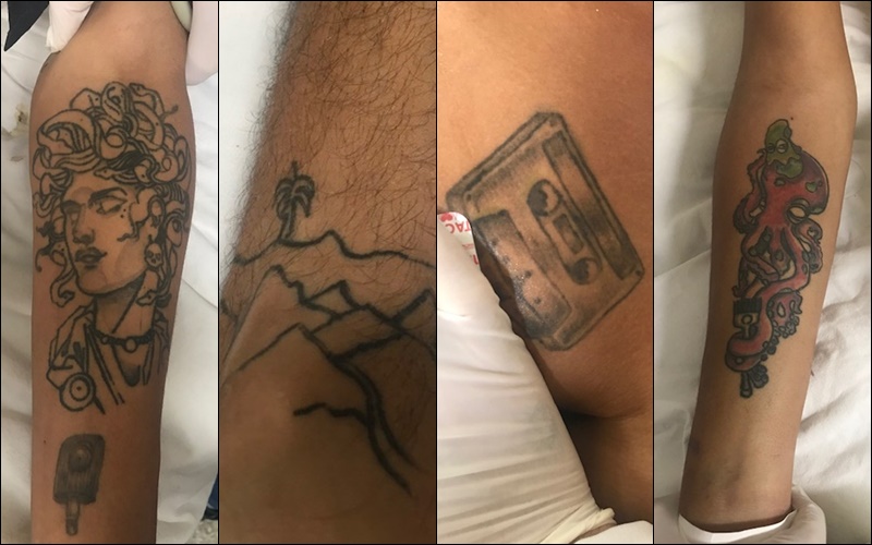 Tatuagens do paciente internado no HUT sem identificação.